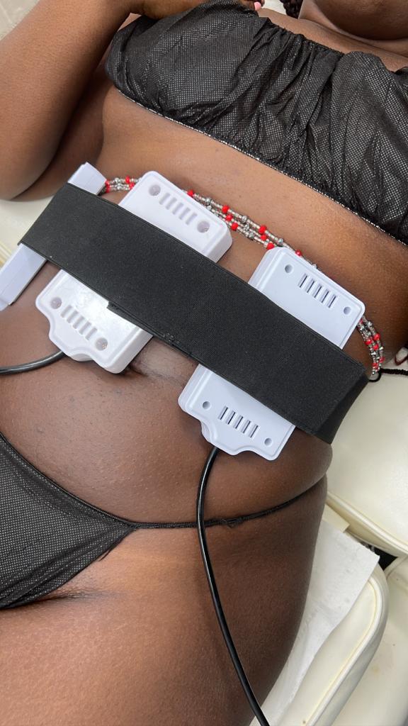 Laser liposuction