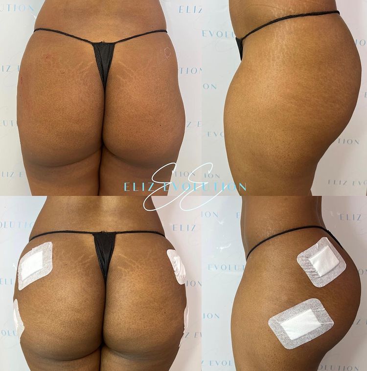 Non-Surgical BBL