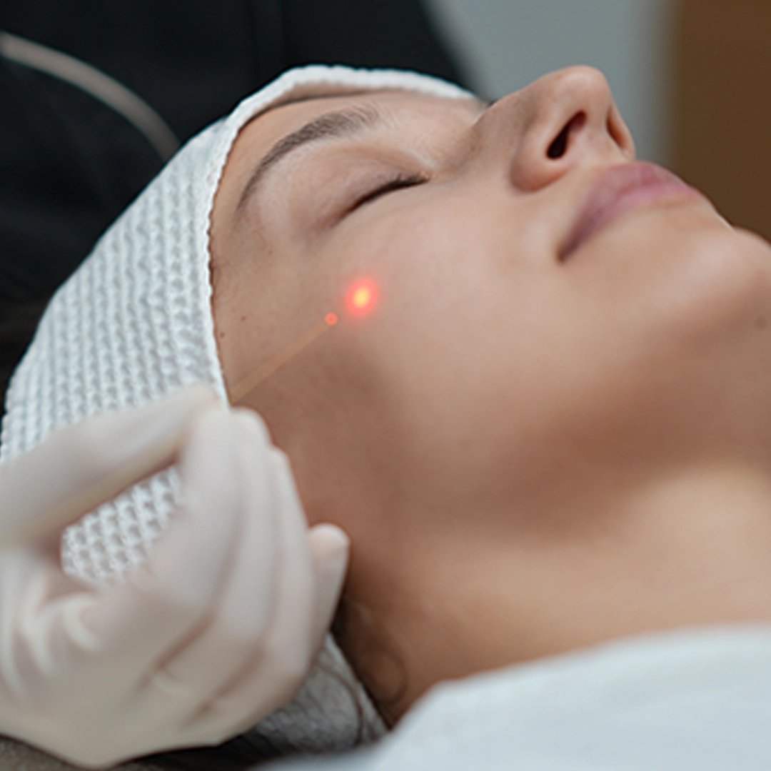 Laser Sculpt result — lower face & neck